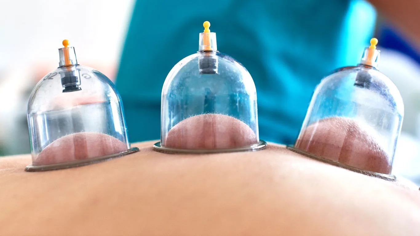 Cupping Therapy