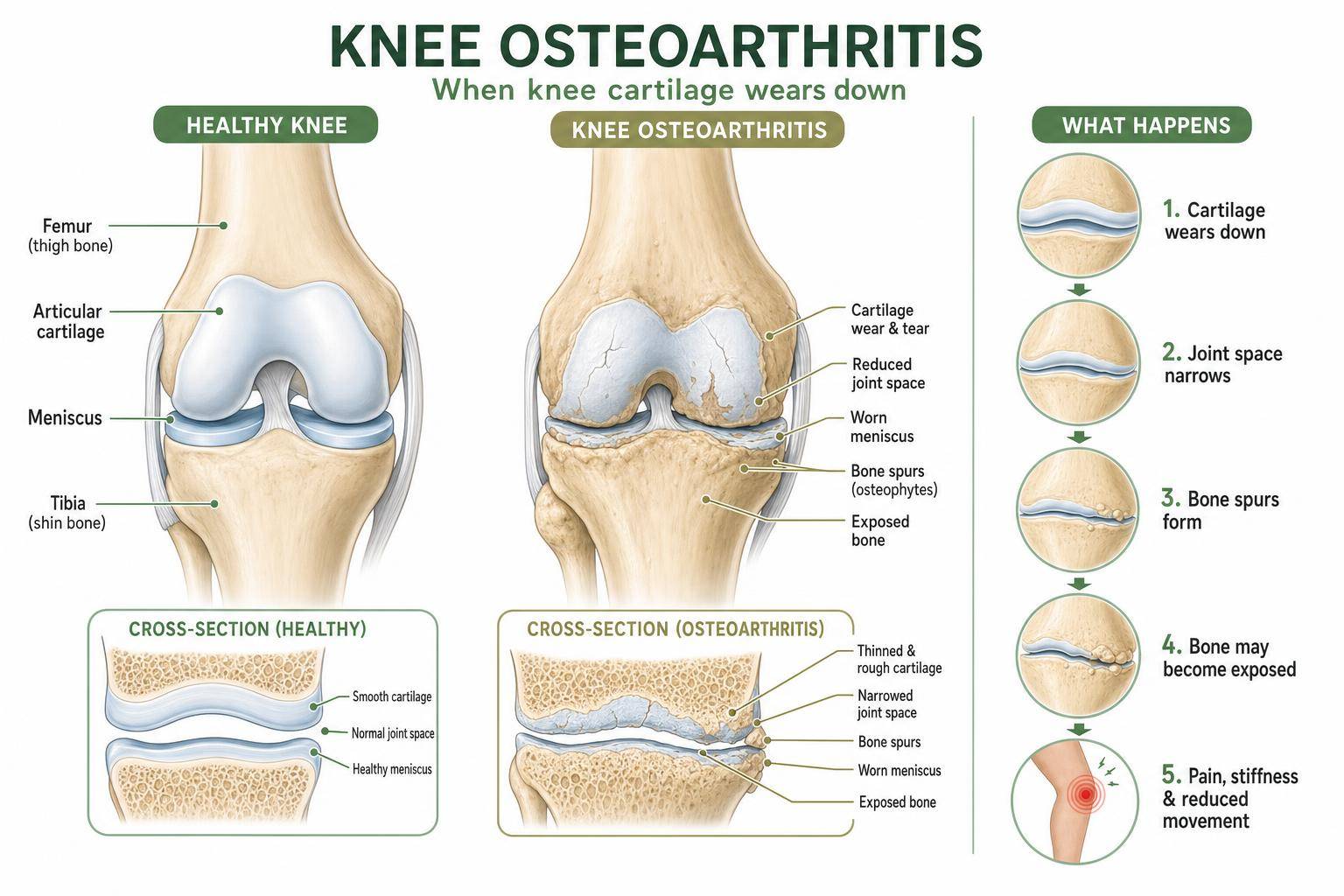 Labeled medical diagram explaining the anatomy of knee osteoarthritis